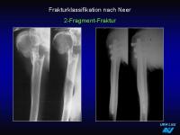 Abbildung 15: Frakturen