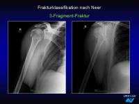 Abbildung 16: Frakturen