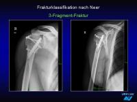 Abbildung 17: Frakturen