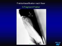 Abbildung 18: Frakturen