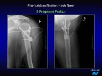Abbildung 19: Frakturen