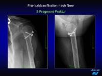 Abbildung 20: Frakturen