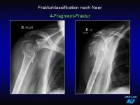Abbildung 21: Frakturen