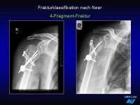 Abbildung 22: Frakturen