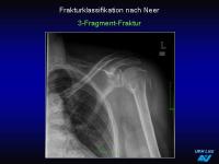 Abbildung 25: Frakturen