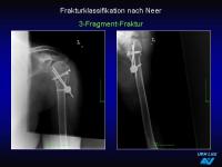Abbildung 26: Frakturen
