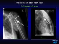 Abbildung 27: Frakturen