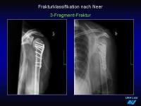 Abbildung 28: Frakturen