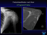 Abbildung 29: Frakturen