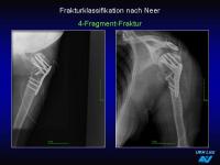 Abbildung 30: Frakturen