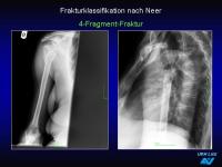Abbildung 31: Frakturen