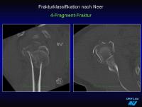Abbildung 32: Frakturen