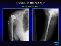 Abbildung 33: Frakturen