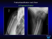 Abbildung 34: Frakturen