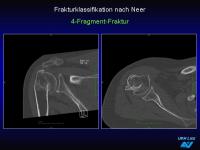 Abbildung 35: Frakturen