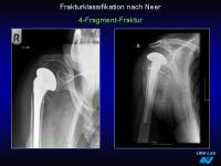 Abbildung 36: Frakturen