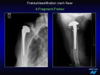 Abbildung 37: Frakturen