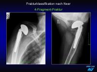 Abbildung 38: Frakturen