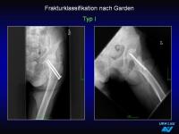 Abbildung 46: Frakturen