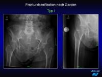 Abbildung 50: Frakturen