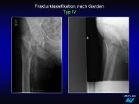 Abbildung 61: Frakturen