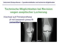 Abbildung 20: Endoprothesen