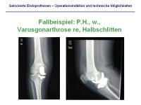 Abbildung 28: Endoprothesen