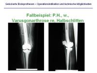 Abbildung 29: Endoprothesen
