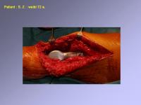 Abbildung 17: Endoprothese