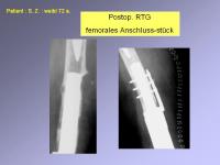 Abbildung 19: Endoprothese
