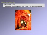 Abbildung 28: Endoprothese
