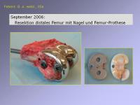 Abbildung 29: Endoprothese