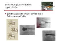 Abbildung 6: Wirbels�ule - Operation