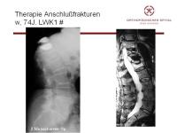 Abbildung 13: Wirbels�ule - Operation