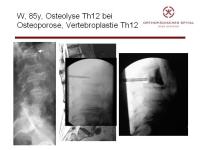 Abbildung 16: Wirbels�ule - Operation