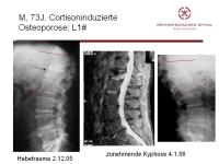 Abbildung 18: Wirbels�ule - Operation