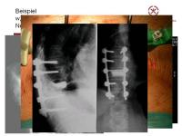 Abbildung 33: Wirbels�ule - Operation