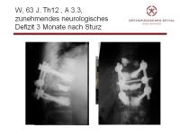 Abbildung 34: Wirbels�ule - Operation