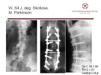 Abbildung 35: Wirbels�ule - Operation