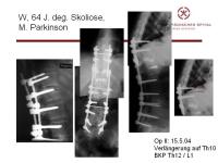 Abbildung 36: Wirbels�ule - Operation