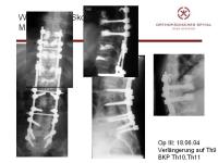 Abbildung 37: Wirbels�ule - Operation