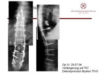 Abbildung 38: Wirbels�ule - Operation