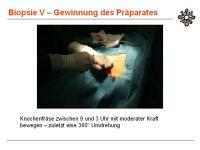 Abbildung 13: Knochenbiopsie