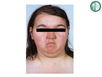 Abbildung 3: Cushing-Syndrom