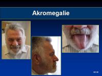 Abbildung 4: Akromegalie