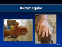 Abbildung 5: Akromegalie