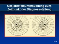 Abbildung 43: Akromegalie