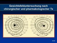Abbildung 45: Akromegalie
