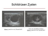 Abbildung 21: Schilddr�senknoten
