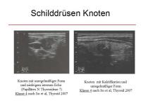 Abbildung 23: Schilddr�senknoten